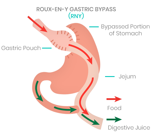 Bariatric Revision Surgery