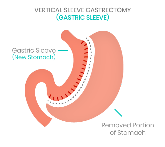 GASTRIC SLEEVE PLICATION 1