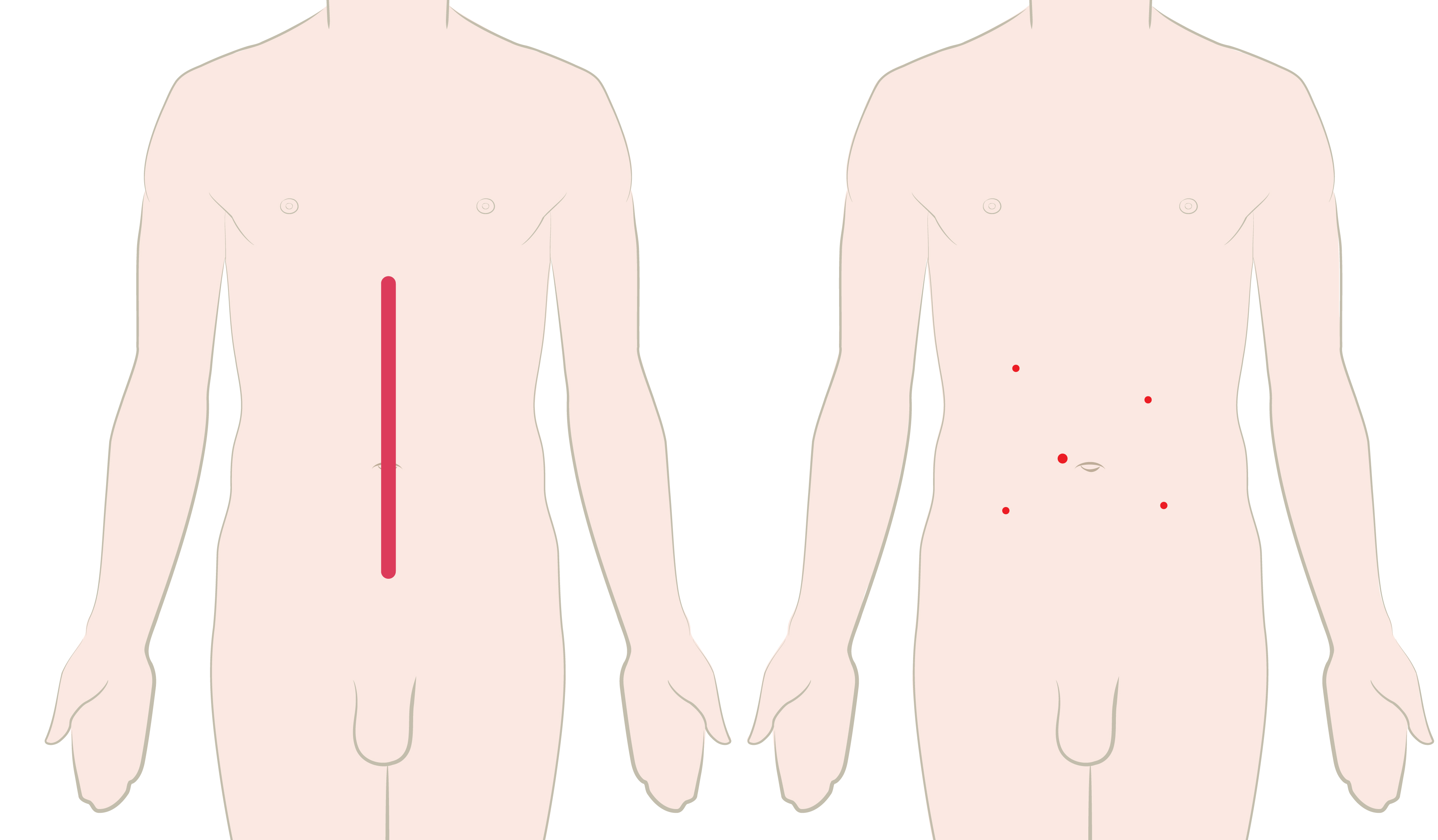 Img036 Incision Comparison Rectal Resection 1