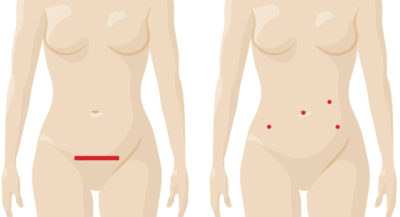 Img038 Incision Comparison Benign Hysterectomy