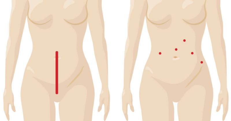 Img039 Incision Comparison Endometrial Cancer Hysterectomy