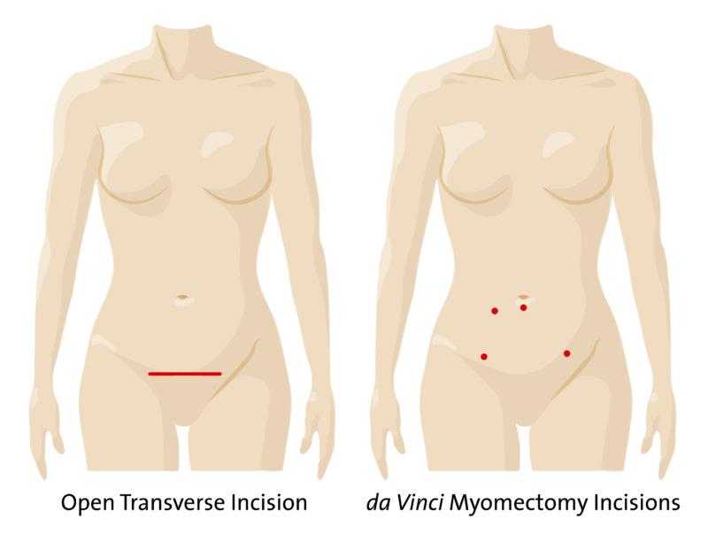 Img041 Incision Comparison Myomectomy