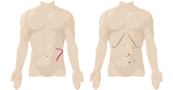 Incision Comparison Partial Nephrectomy
