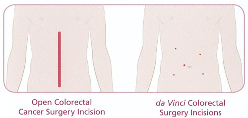 Colorectal 1 low anterior