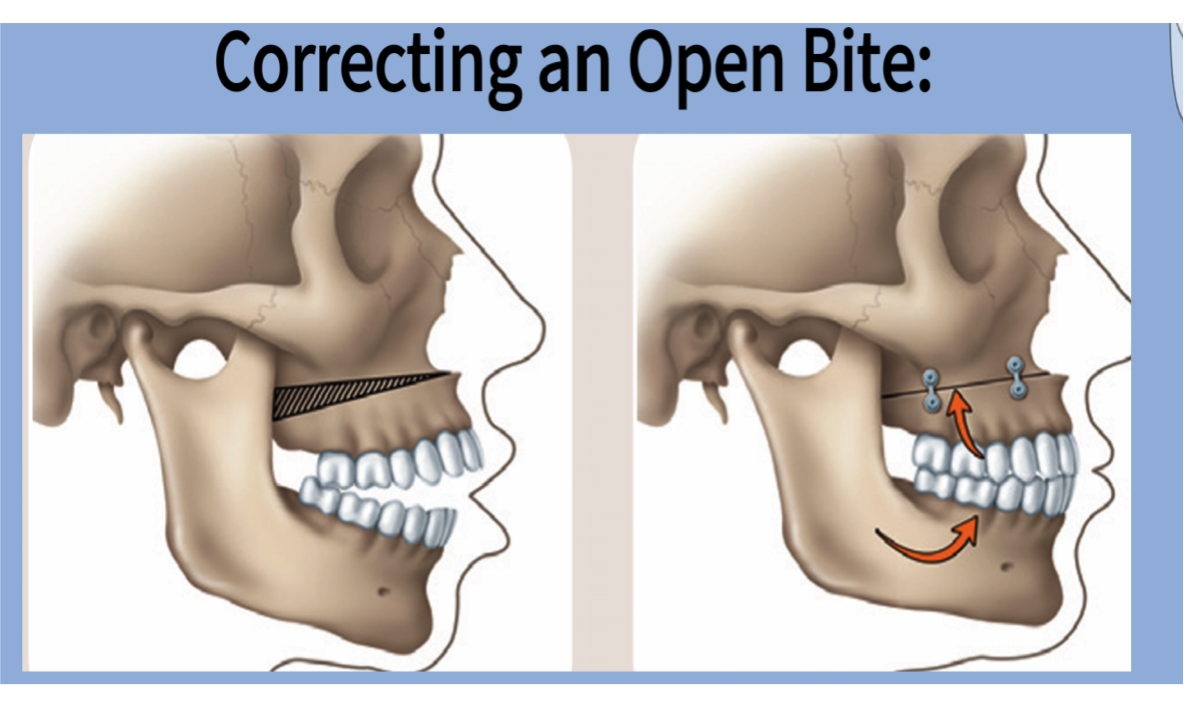 correcting-an-open-bite-with-jaw-surgery