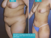 Liposuction_001