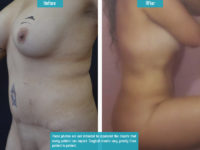 Liposuction_002