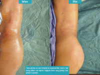 Liposuction_004