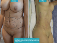 Liposuction_006