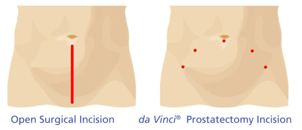 Incision comparison Prostectatomy