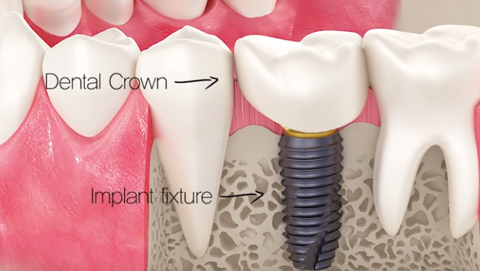Dental crowns