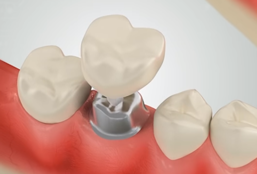 final crown placement